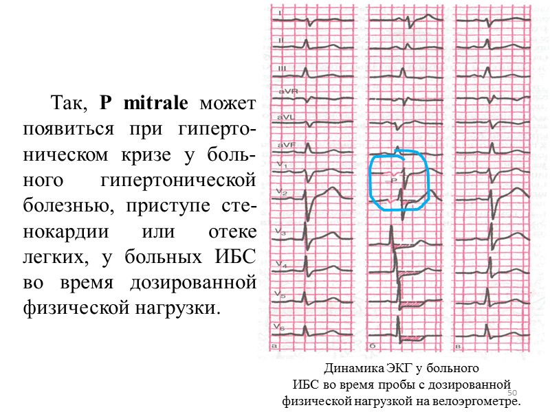 50 Так, Р mitrale может появиться при гиперто-ническом кризе 50 Так, Р mitrale может появиться при гиперто-ническом кризе